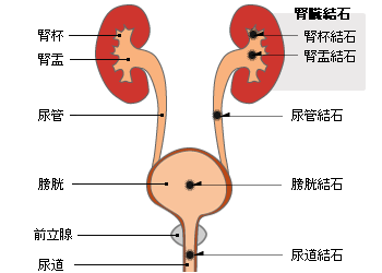 腎結石